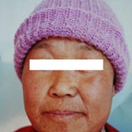 治疗后