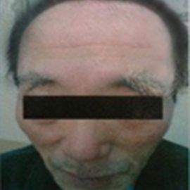 治疗后