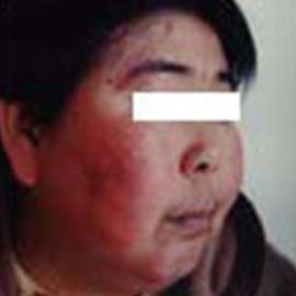 治疗后