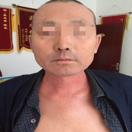 治疗前