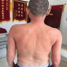 治疗前