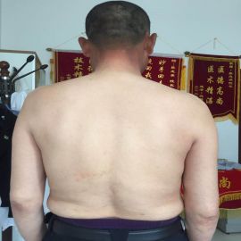 治疗后