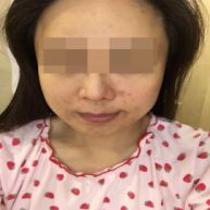 面部痤疮