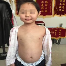治疗后