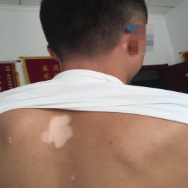 治疗前