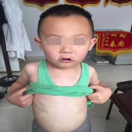 治疗后