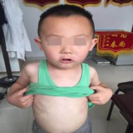 急性过敏性皮炎