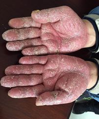 脓泡性银屑病