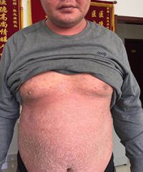 红皮症型银屑病