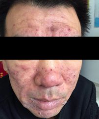 酒糟性皮炎