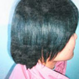 治疗后